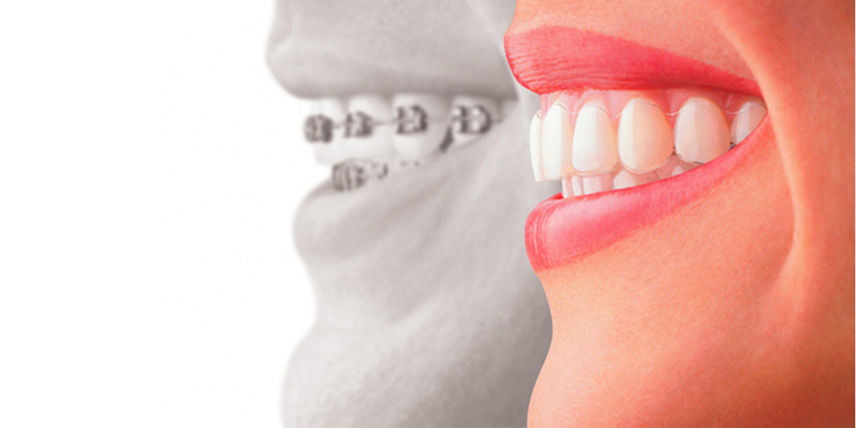 5 Things You Wish You Knew Before Having Invisalign - Keep 28 Dental