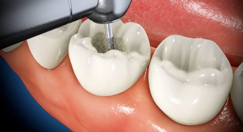 What is a Cavity Filling? - Keep 28 Dental